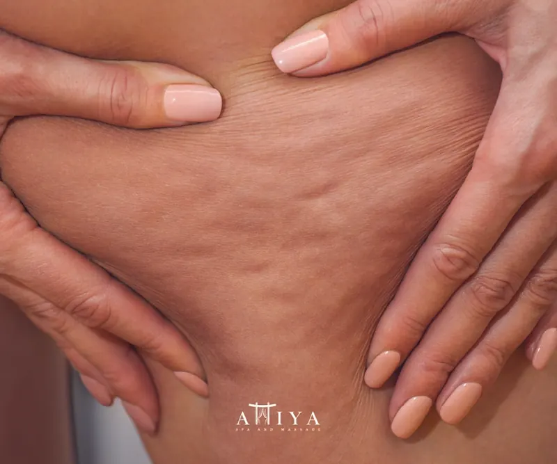 CELLULITE & SLIMMING Image